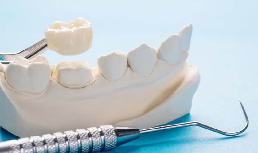 dental crown in Chandler