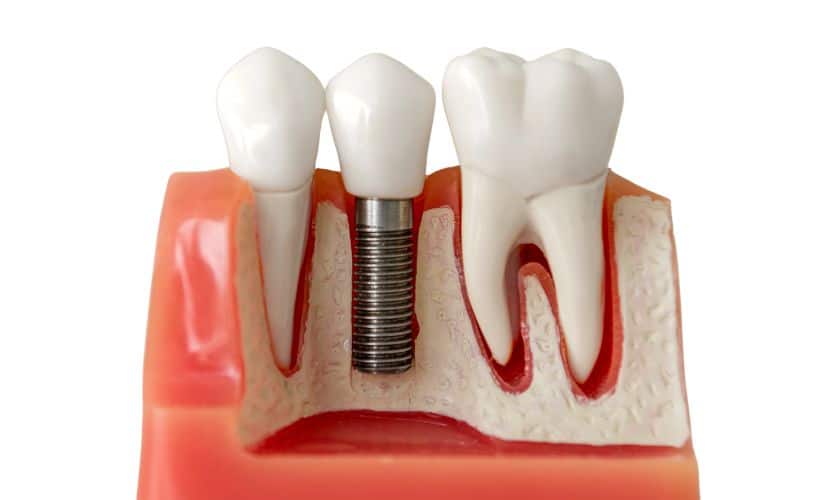 Dental Implants in Chandler AZ