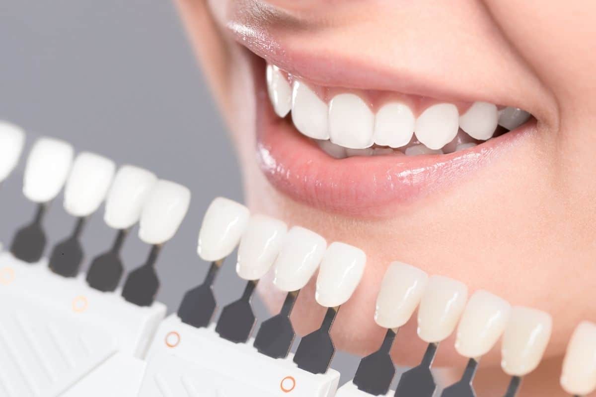 Porcelain Veneers vs Teeth Whitening