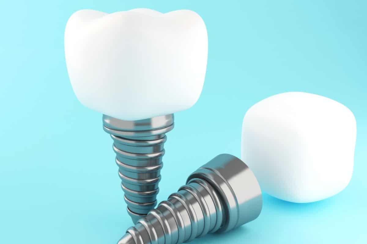 Dental Implants in Chandler