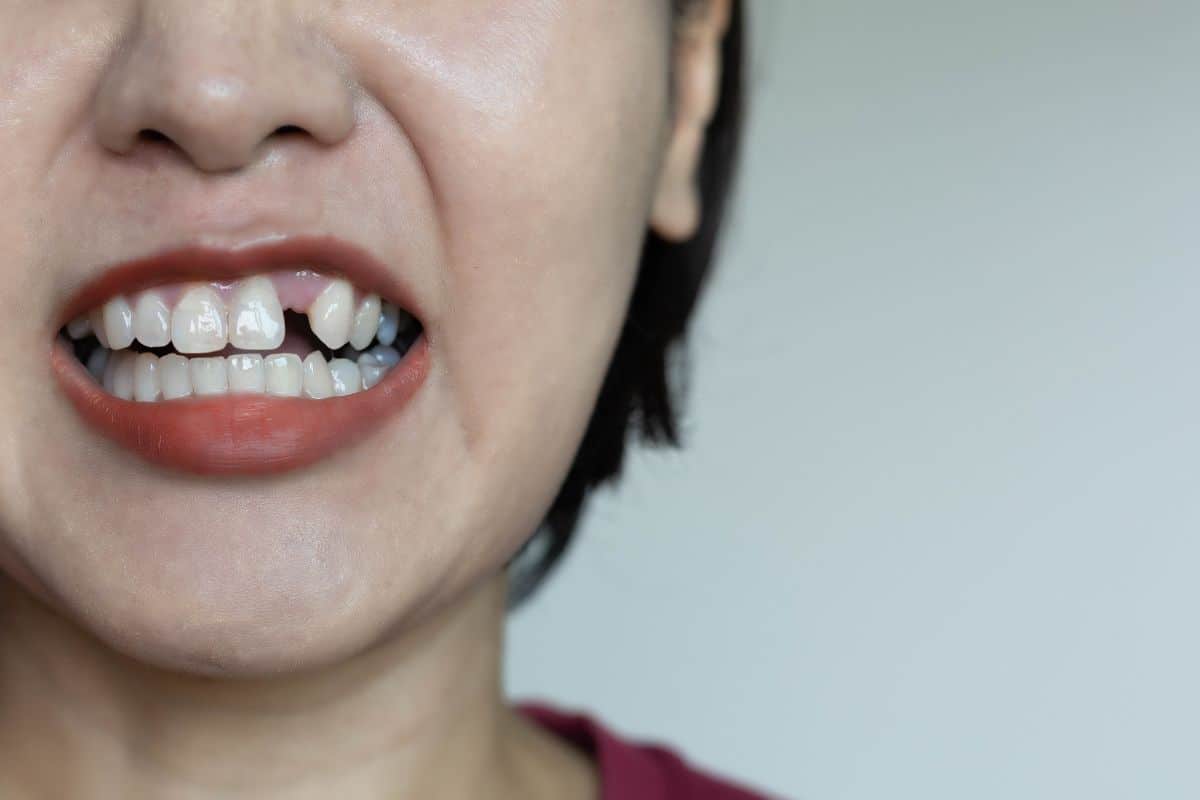 way to fix checked tooth by Chandler dentist