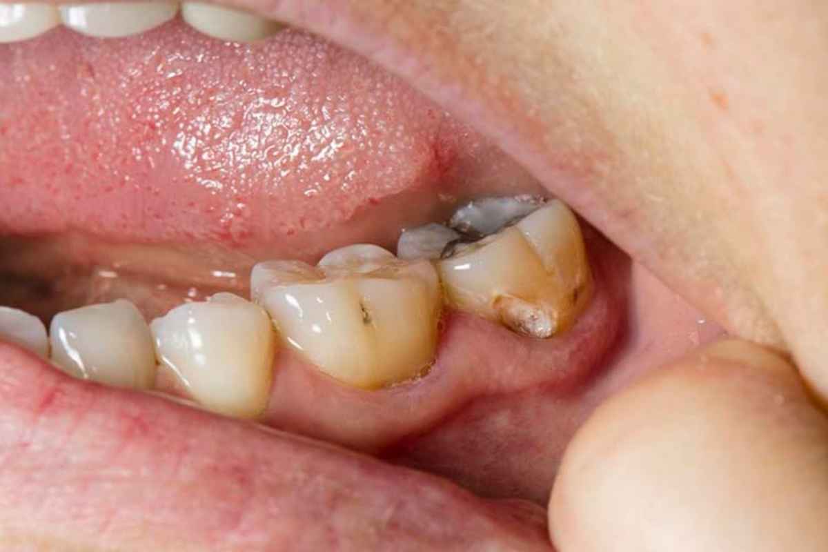 Signs of Cavities You Shouldn’t Ignore