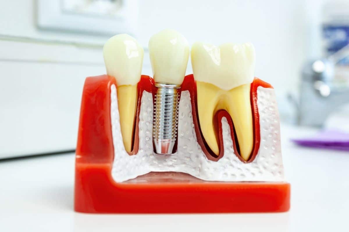 Dental implants chandler