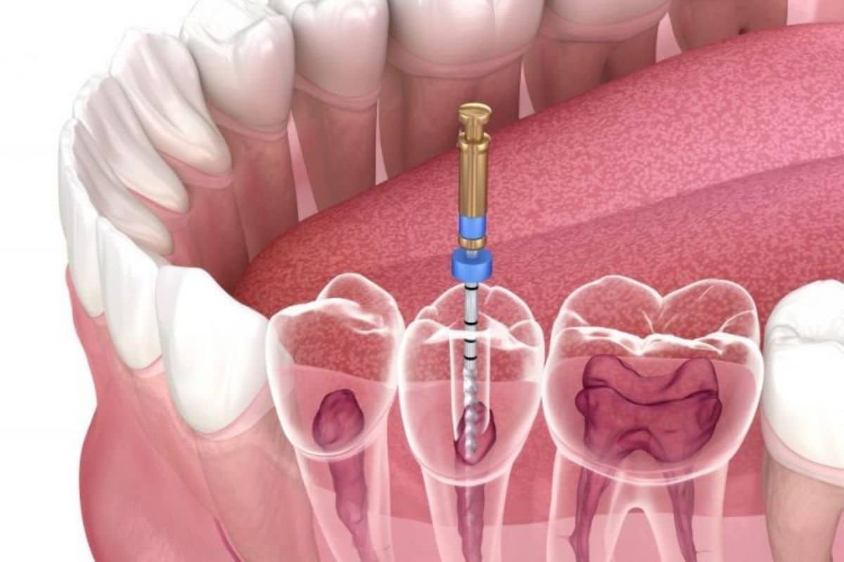 Root Canal