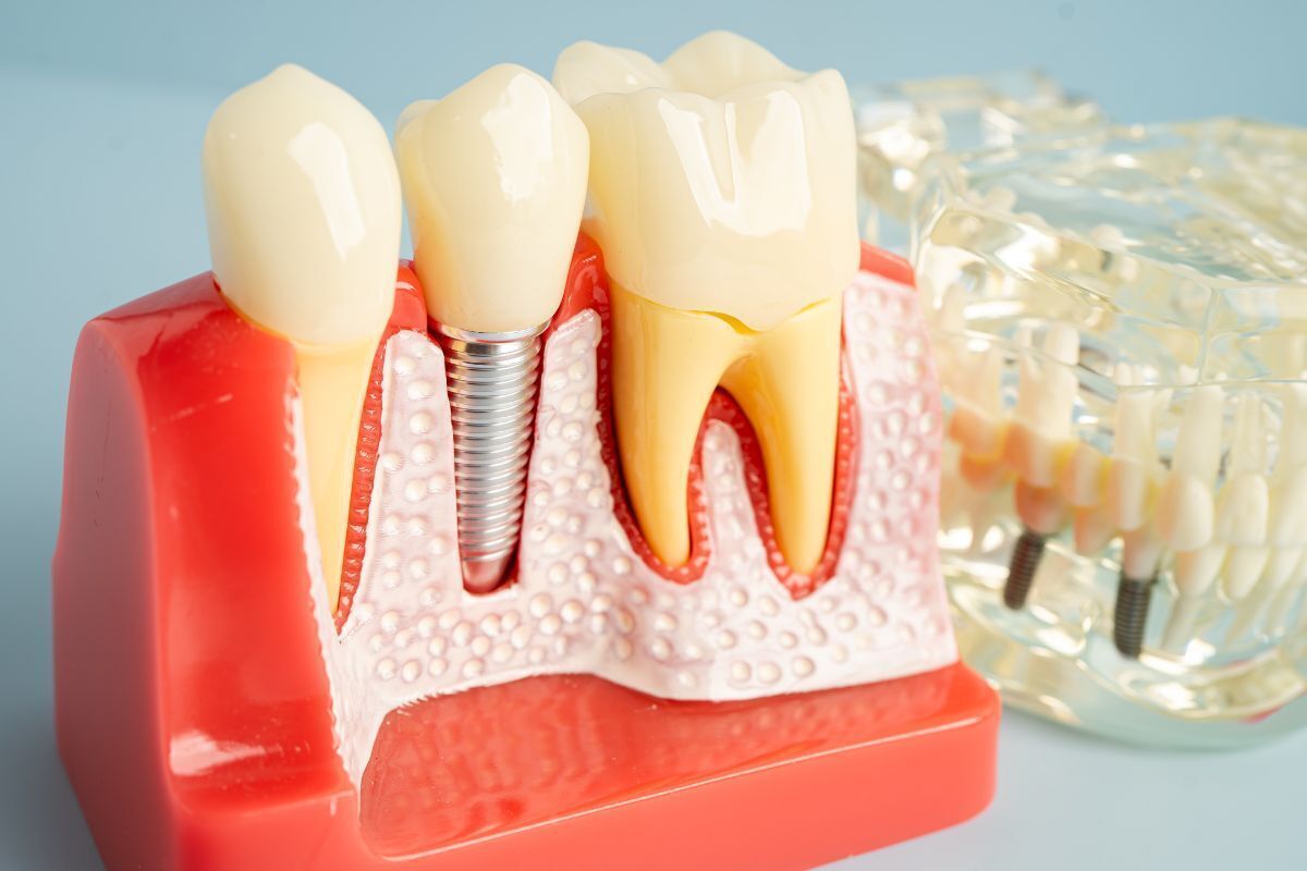Dental implant model showing tooth replacement options with crown, implant post, and natural tooth structure.