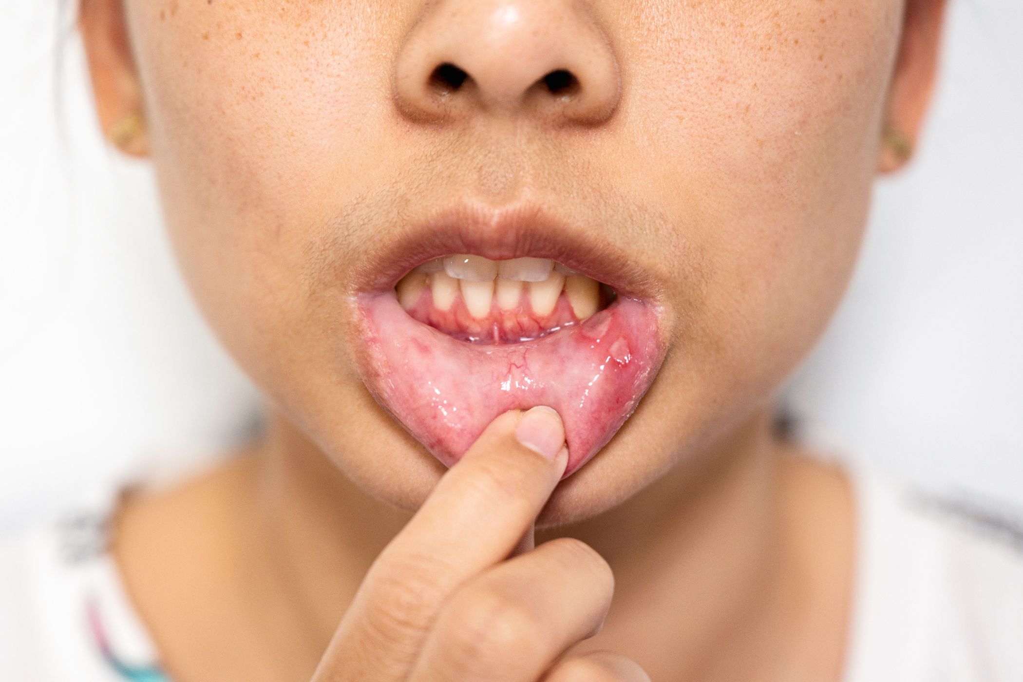 Canker Sores
