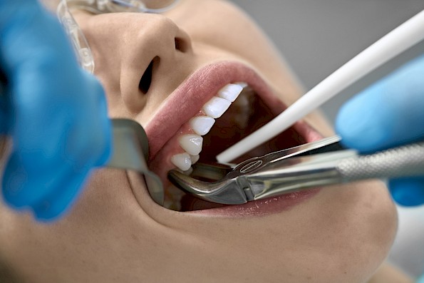 Tooth extraction procedure.
