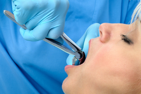 Woman undergoing surgical tooth extraction