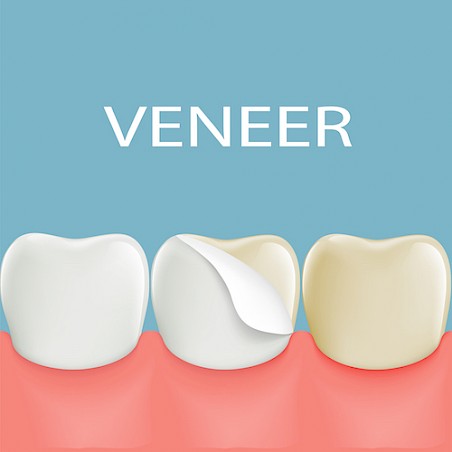 Difference Between Dental Bonding and Veneers